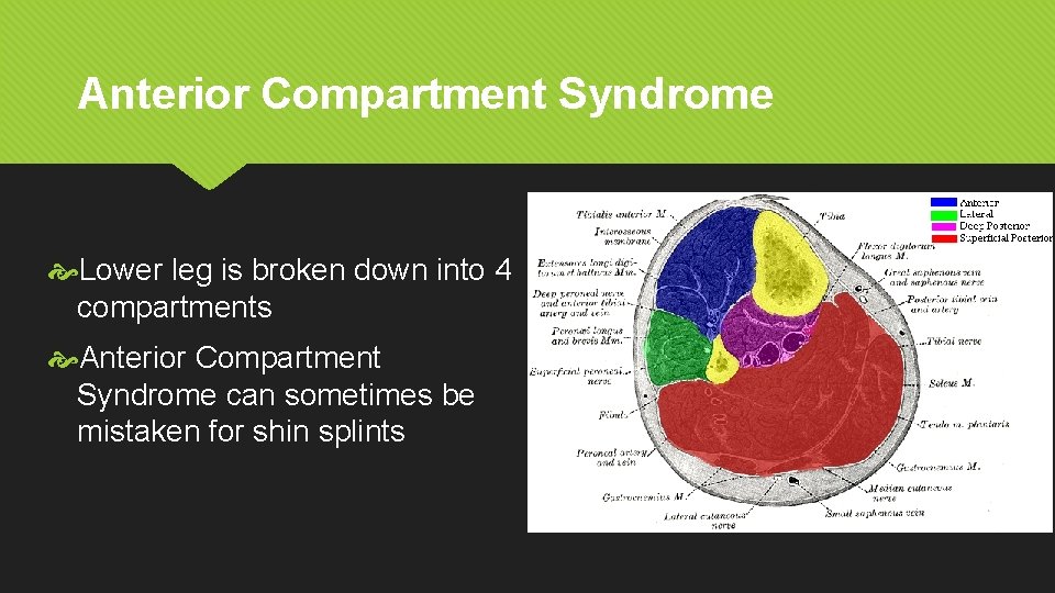 Anterior Compartment Syndrome Lower leg is broken down into 4 compartments Anterior Compartment Syndrome
