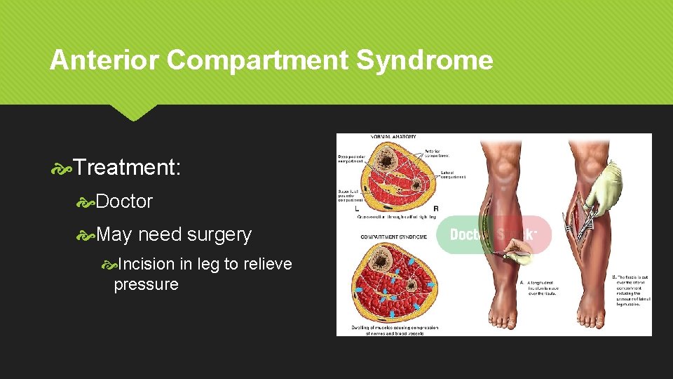 Anterior Compartment Syndrome Treatment: Doctor May need surgery Incision in leg to relieve pressure