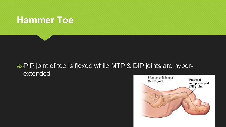 Hammer Toe PIP joint of toe is flexed while MTP & DIP joints are