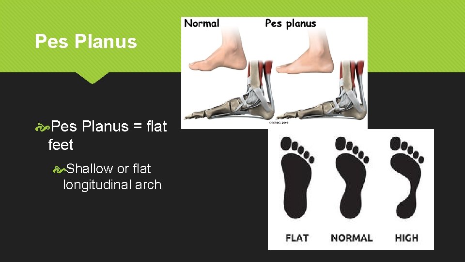 Pes Planus = flat feet Shallow or flat longitudinal arch 