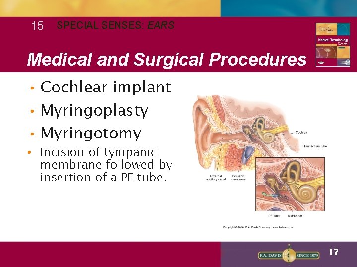 15 SPECIAL SENSES: EARS Medical and Surgical Procedures • Cochlear implant • Myringoplasty •