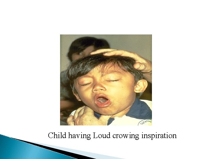 Child having Loud crowing inspiration Child having Loud crowing inspiration