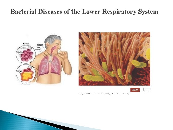 Bacterial Diseases of the Lower Respiratory System Bacterial Diseases of the Lower Respiratory System