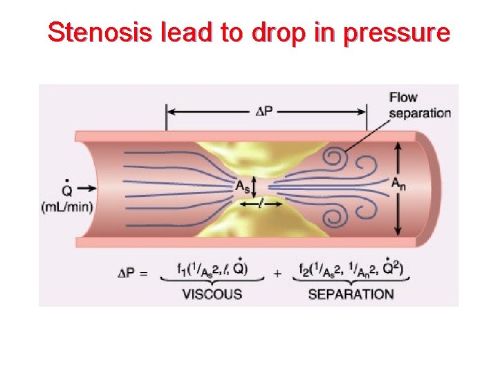 Stenosis lead to drop in pressure 