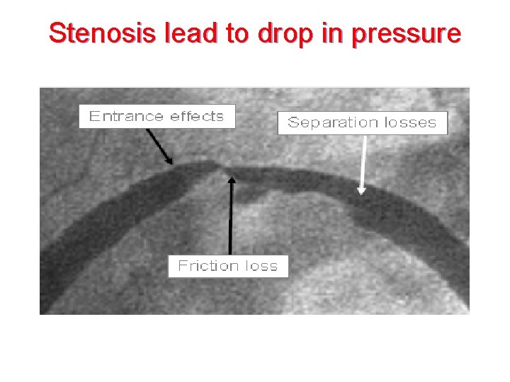 Stenosis lead to drop in pressure 