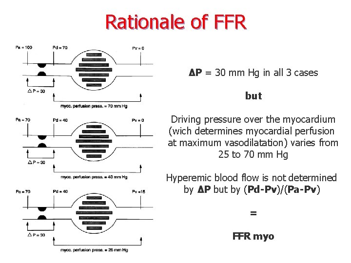 Rationale of FFR ΔP = 30 mm Hg in all 3 cases but Driving