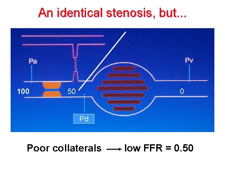 An identical stenosis, but. . . • 26 col-schema fcf (figuur) 100 50 0