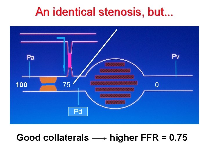 An identical stenosis, but. . . • 26 col-schema fcf (figuur) 100 75 0