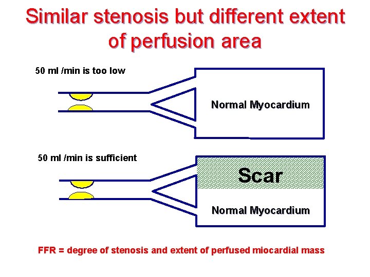 Similar stenosis but different extent of perfusion area 50 ml /min is too low