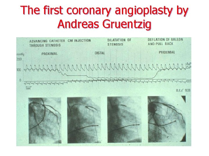 The first coronary angioplasty by Andreas Gruentzig 