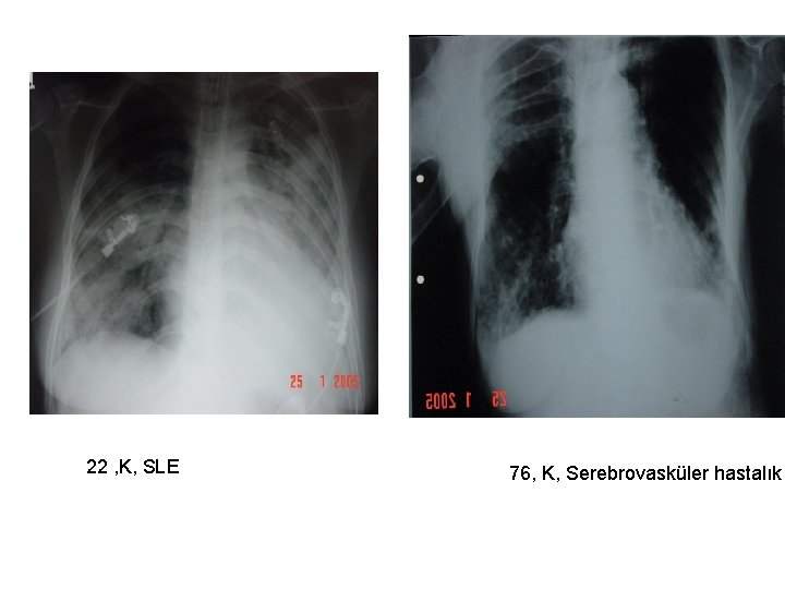 22 , K, SLE 76, K, Serebrovasküler hastalık 
