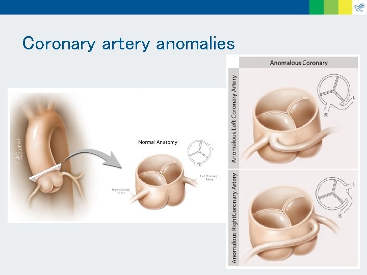 Coronary artery anomalies 