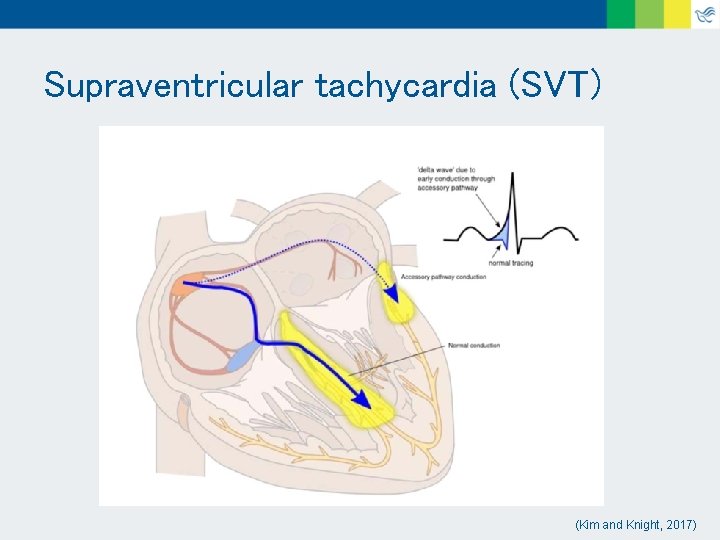 Supraventricular tachycardia (SVT) (Kim and Knight, 2017) 