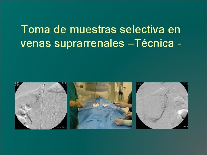 Toma de muestras selectiva en venas suprarrenales –Técnica - 