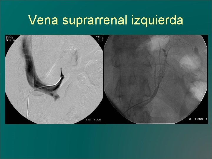 Vena suprarrenal izquierda 