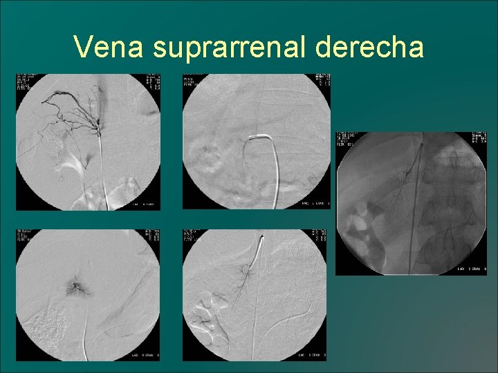 Vena suprarrenal derecha 