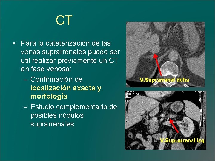 CT • Para la cateterización de las venas suprarrenales puede ser útil realizar previamente