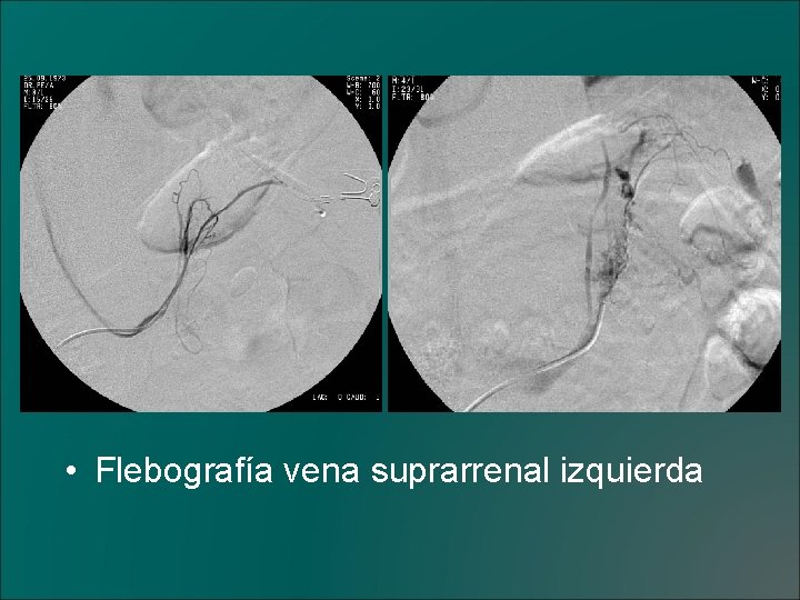  • Flebografía vena suprarrenal izquierda 