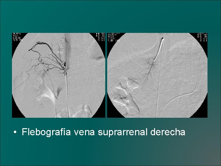  • Flebografía vena suprarrenal derecha 