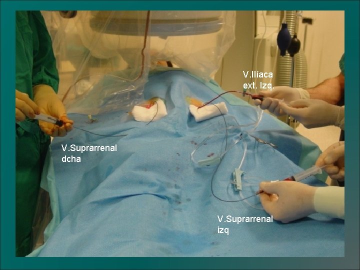 V. Ilíaca ext. Izq. V. Suprarrenal dcha V. Suprarrenal izq 