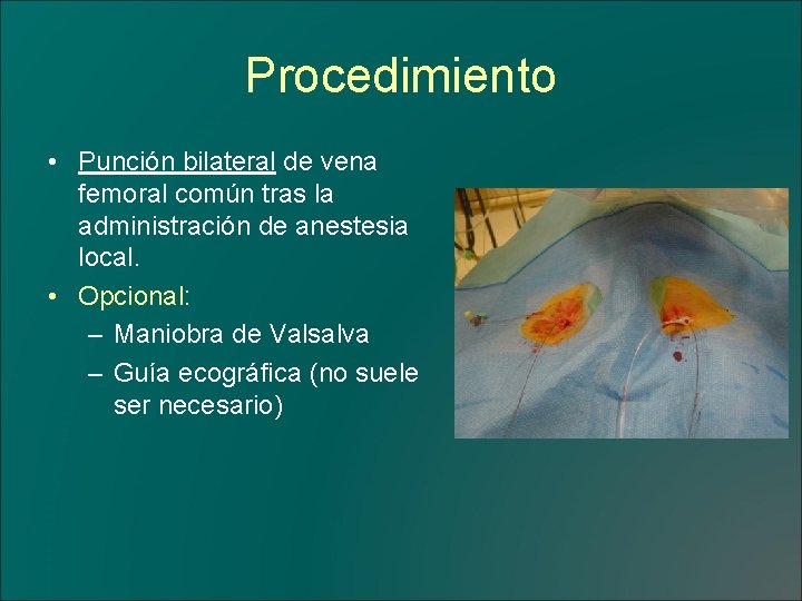Procedimiento • Punción bilateral de vena femoral común tras la administración de anestesia local.