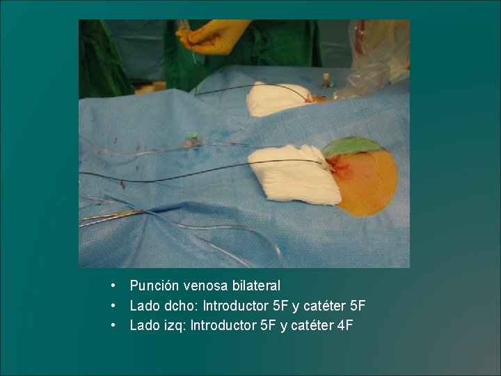  • Punción venosa bilateral • Lado dcho: Introductor 5 F y catéter 5