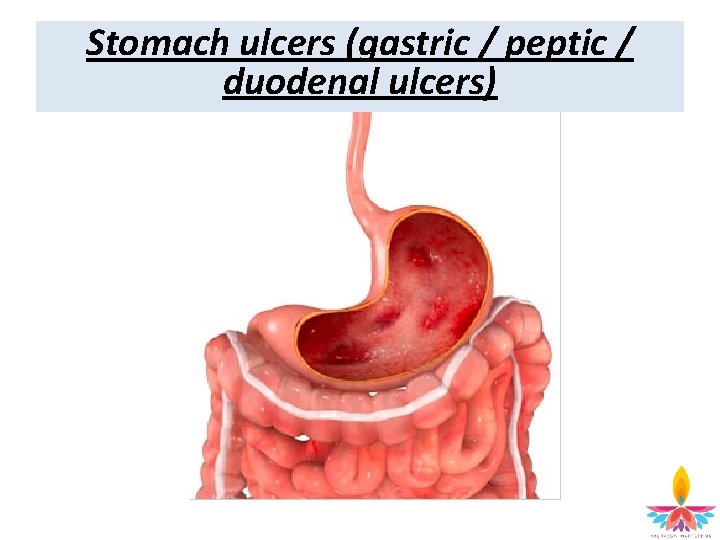 Stomach ulcers (gastric / peptic / duodenal ulcers) 