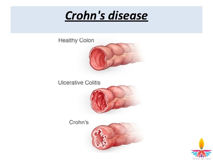 Crohn's disease 