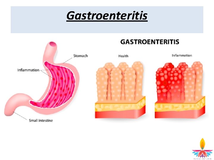 Gastroenteritis 