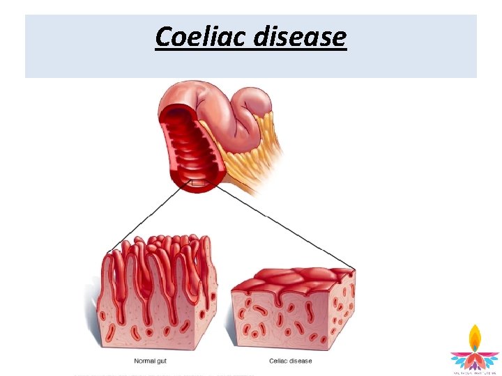 Coeliac disease 