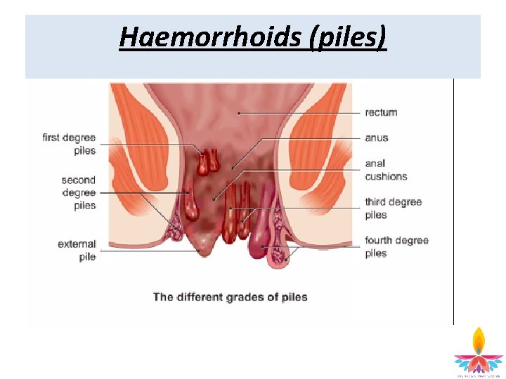 Haemorrhoids (piles) 