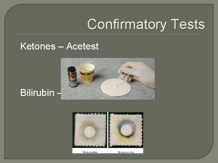 Confirmatory Tests Ketones – Acetest Bilirubin – Ictotest 
