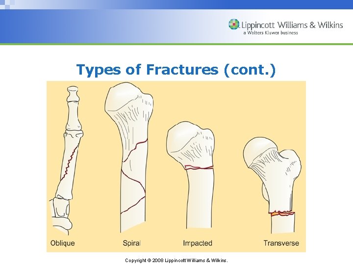 Types of Fractures (cont. ) Copyright © 2008 Lippincott Williams & Wilkins. 