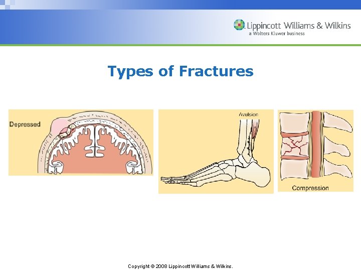 Types of Fractures Copyright © 2008 Lippincott Williams & Wilkins. 