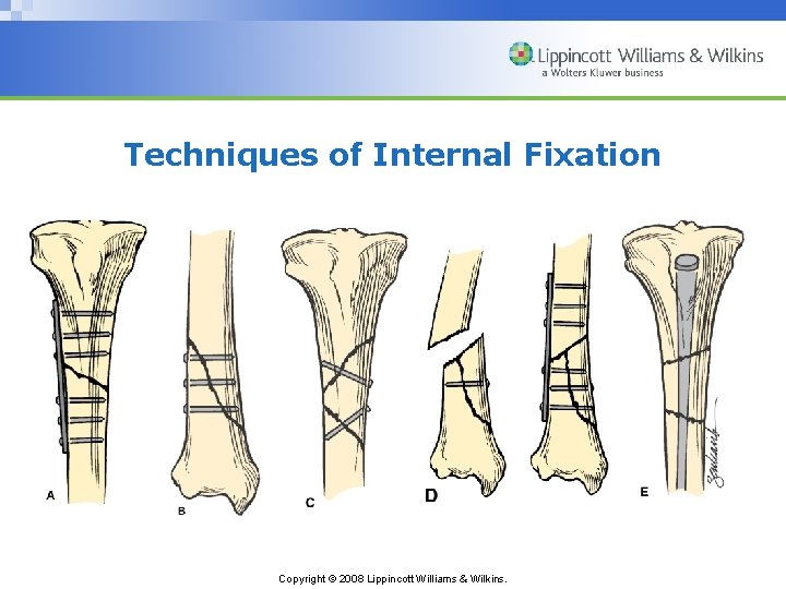 Techniques of Internal Fixation Copyright © 2008 Lippincott Williams & Wilkins. 