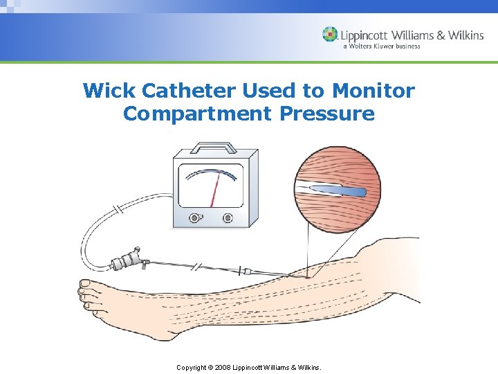 Wick Catheter Used to Monitor Compartment Pressure Copyright © 2008 Lippincott Williams & Wilkins.