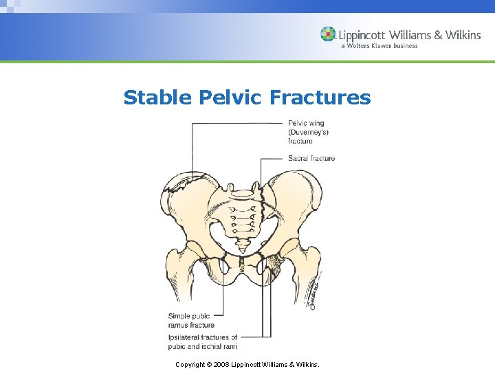 Stable Pelvic Fractures Copyright © 2008 Lippincott Williams & Wilkins. 