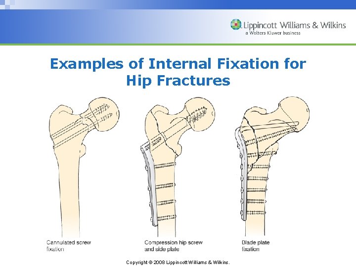 Examples of Internal Fixation for Hip Fractures Copyright © 2008 Lippincott Williams & Wilkins.