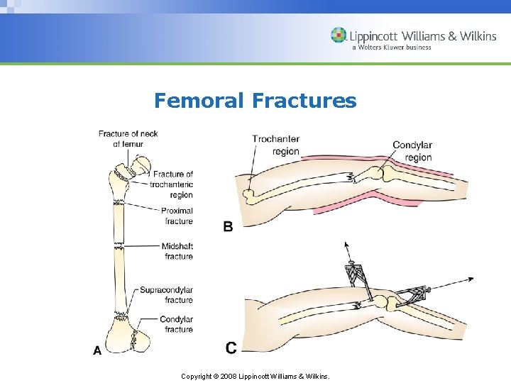 Femoral Fractures Copyright © 2008 Lippincott Williams & Wilkins. 