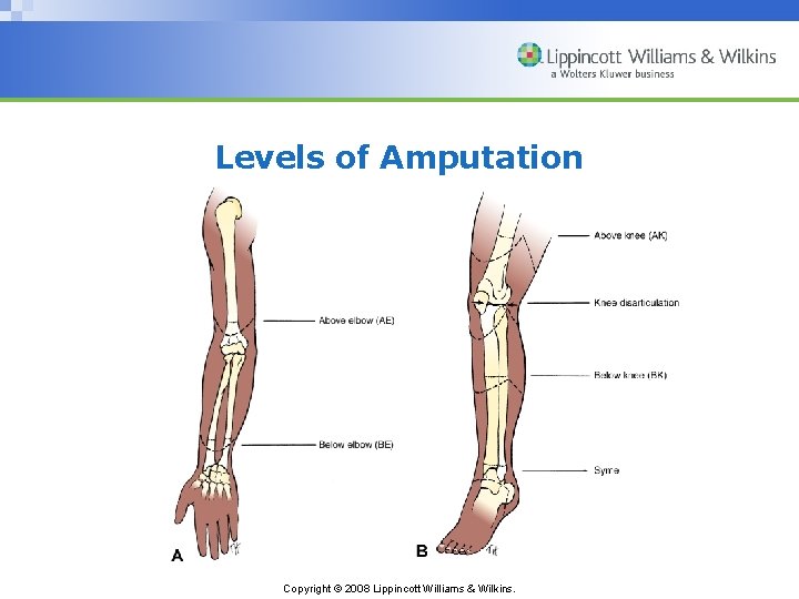 Levels of Amputation Copyright © 2008 Lippincott Williams & Wilkins. 