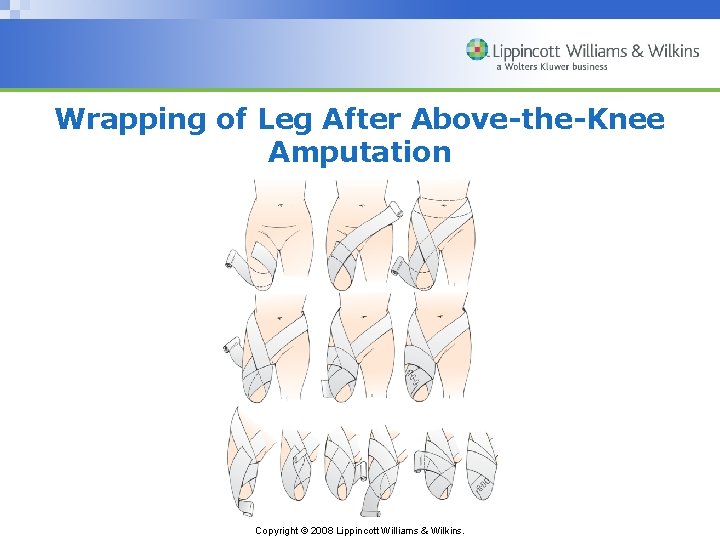 Wrapping of Leg After Above-the-Knee Amputation Copyright © 2008 Lippincott Williams & Wilkins. 