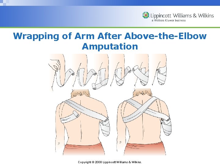 Wrapping of Arm After Above-the-Elbow Amputation Copyright © 2008 Lippincott Williams & Wilkins. 