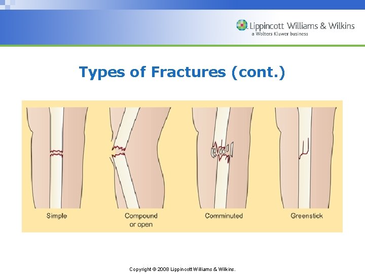Types of Fractures (cont. ) Copyright © 2008 Lippincott Williams & Wilkins. 