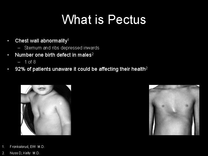 What is Pectus • Chest wall abnormality 1 – Sternum and ribs depressed inwards What is Pectus • Chest wall abnormality 1 – Sternum and ribs depressed inwards