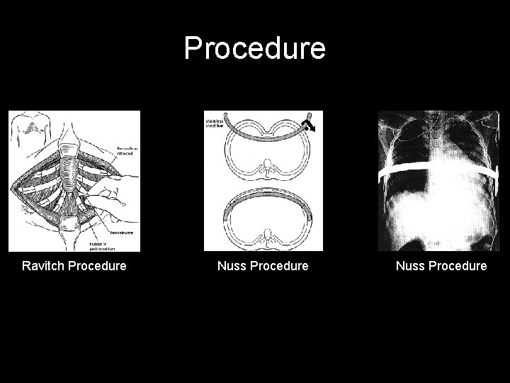 Procedure Ravitch Procedure Nuss Procedure Procedure Ravitch Procedure Nuss Procedure