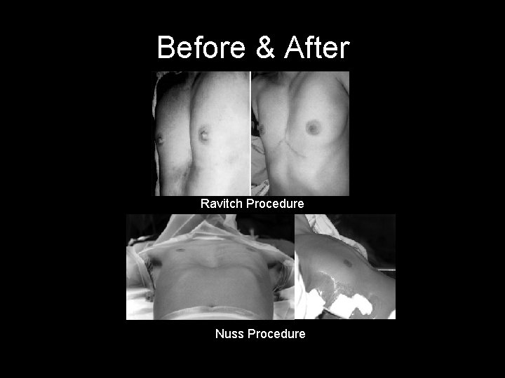 Before & After Ravitch Procedure Nuss Procedure 