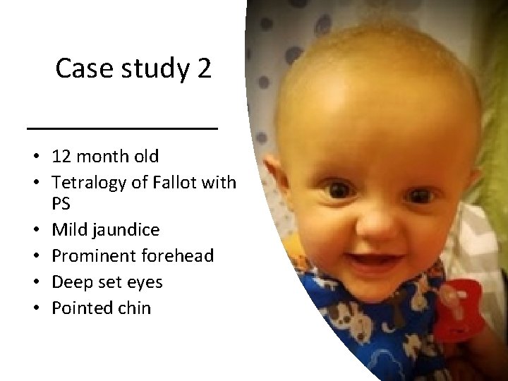 Case study 2 • 12 month old • Tetralogy of Fallot with PS •