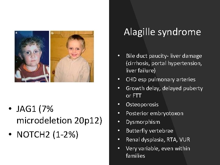 Alagille syndrome • JAG 1 (7% microdeletion 20 p 12) • NOTCH 2 (1