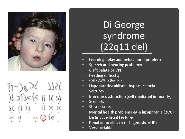 Di George syndrome (22 q 11 del) • • • • Learning delay and