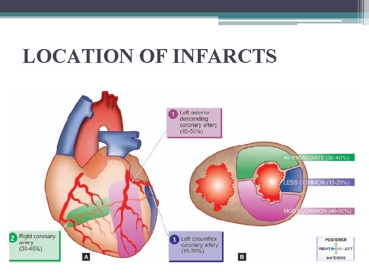 LOCATION OF INFARCTS 